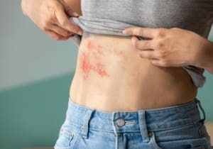 Shingles Survival Guide: Spot It, Treat It, Prevent It