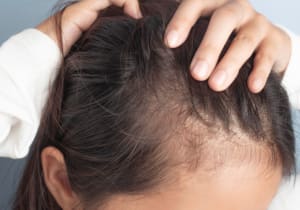 Hair Loss in Women: Causes, Treatments & How Harpenden Medical Health & Wellness Can Help